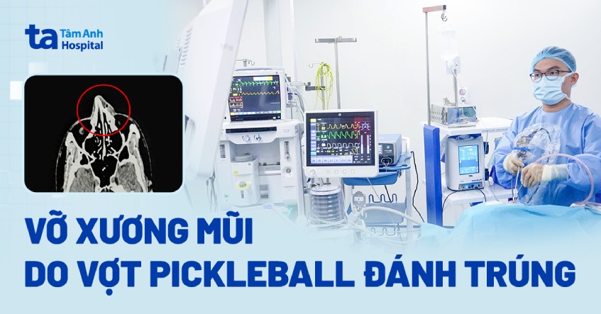 Vỡ xương mũi do vợt Pickleball đánh trúng