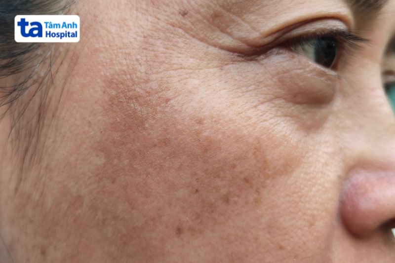 da tăng sắc tố ở các vết bắn laser 