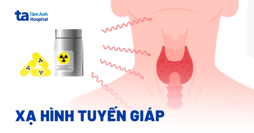 Xạ hình tuyến giáp: Khi nào cần làm? Hết bao nhiêu tiền?