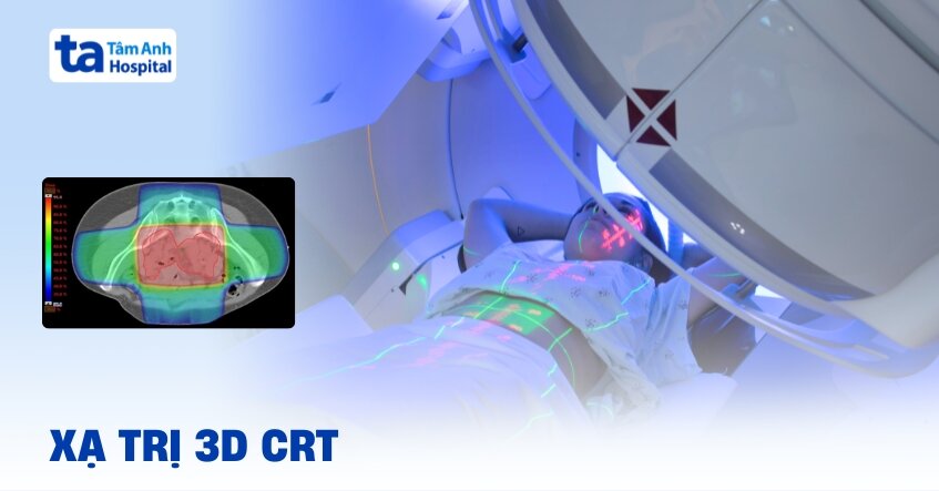 Xạ trị 3D CRT là gì?