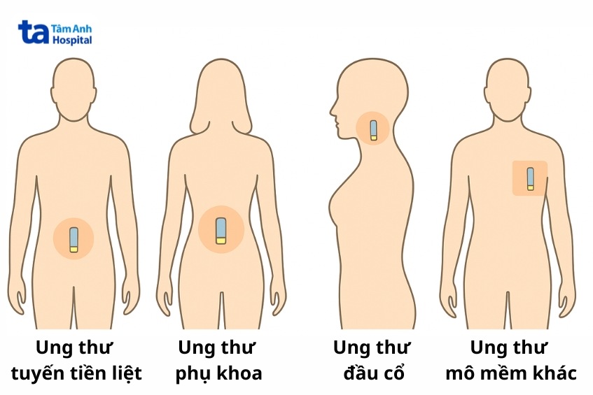 xạ trị áp sát liều cao có thể được chỉ định cho nhiều bệnh ung thư
