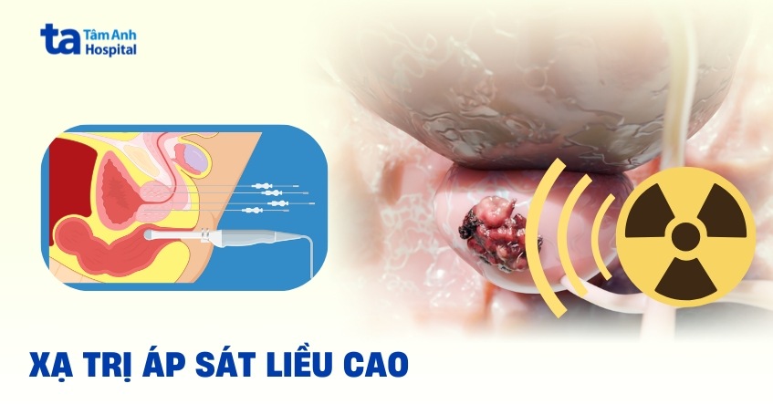 Bạn biết gì về xạ trị áp sát liều cao không?