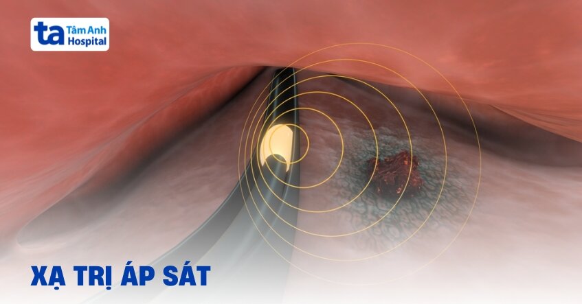 Xạ trị áp sát (xạ trị trong) là gì? Quy trình thực hiện