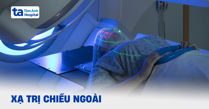 Các phương pháp xạ trị chiếu ngoài phổ biến hiện nay
