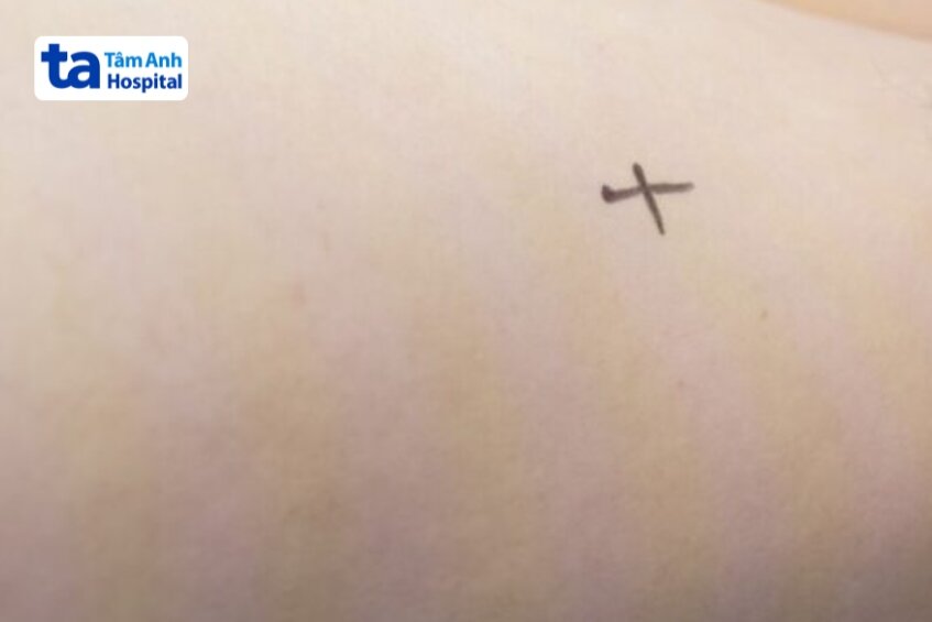 xác định vùng xạ trị