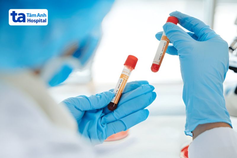 xét nghiệm máu chẩn đoán bệnh lupus