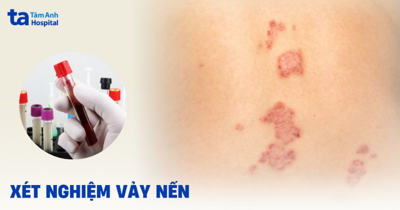 Xét nghiệm vảy nến gồm những phương pháp gì?