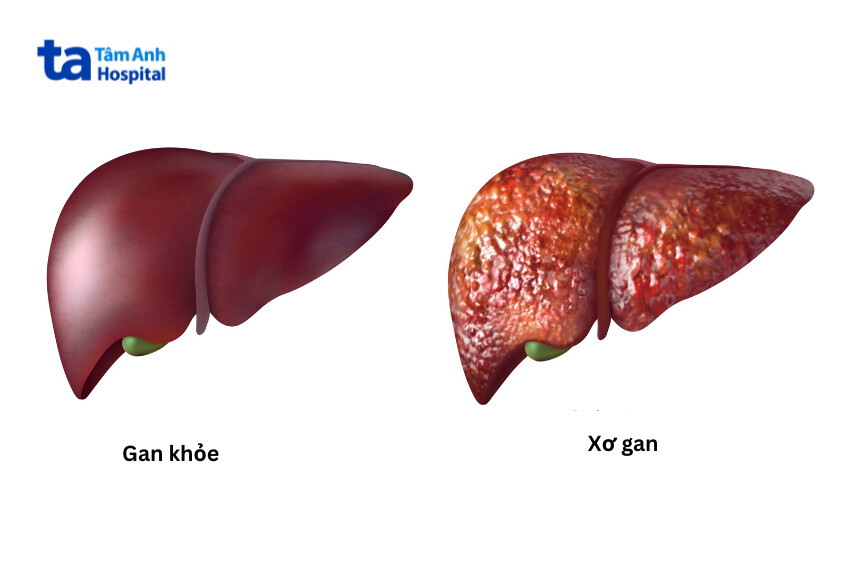 Xơ gan có thể ảnh hưởng gây giãn và nổi tĩnh mạch cổ