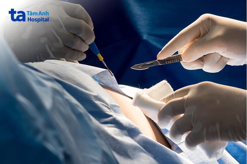 Chỉ định phẫu thuật ung thư tụy