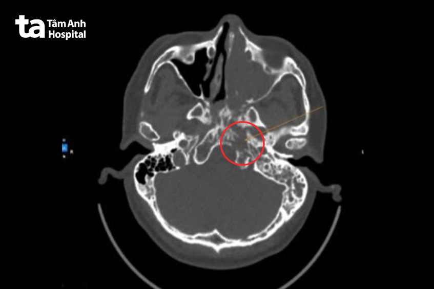 ảnh CT khối u hốc mũi