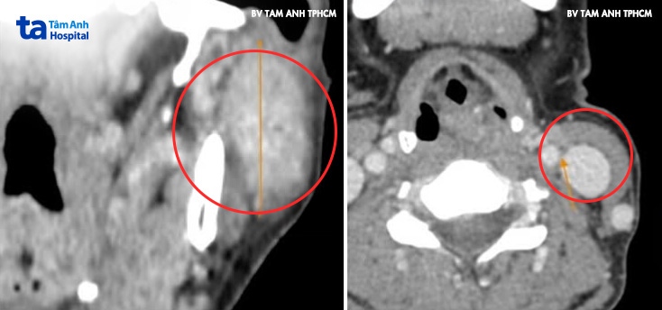 ảnh CT khối u lớn