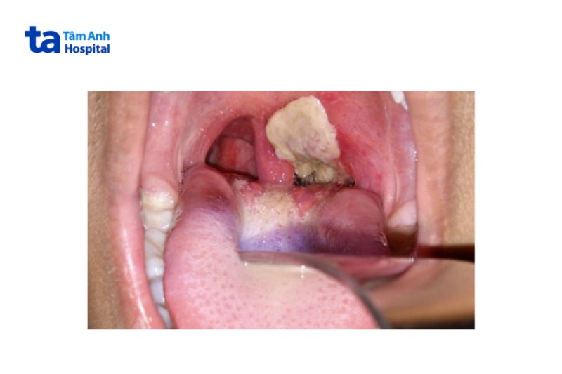 ảnh bệnh bạch hầu