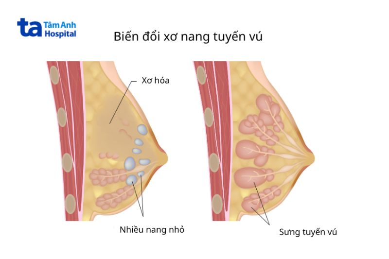 ảnh minh họa biến đổi xơ nang tuyến vú