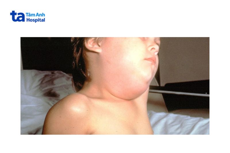 hình ảnh bệnh quai bị trên lâm sàng