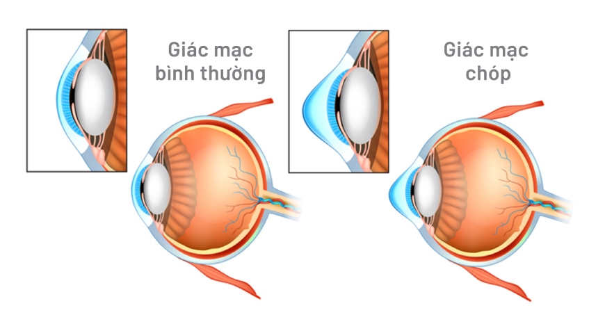 ảnh mô phỏng giác mạc chóp (phải) và giác mạc bình thường ; ảnh_ eye institute