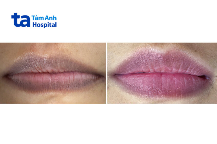 ảnh và trước sau khi điều trị