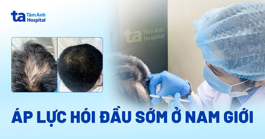 Áp lực hói đầu sớm ở nam giới