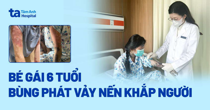 Bé gái 6 tuổi bùng phát vảy nến khắp người