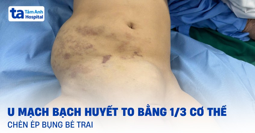 Bé trai bị chèn ép ổ bụng bởi u mạch bạch huyết to bằng 1/3 cơ thể