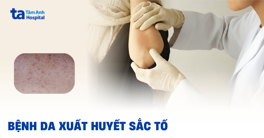 Các bệnh da xuất huyết tăng sắc tố khá phổ biến