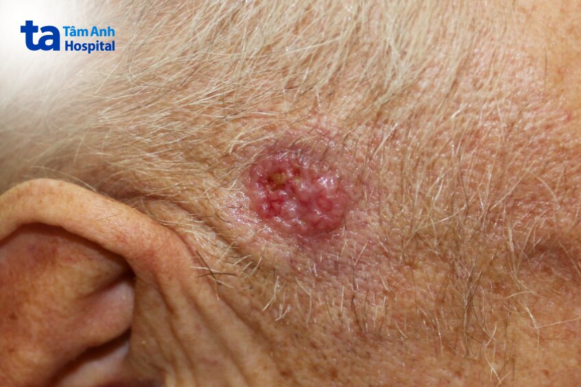 bệnh nhân ung thư da đầu