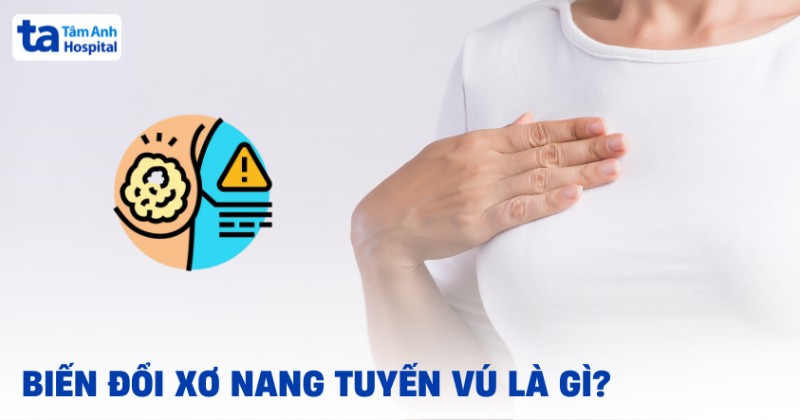Biến đổi xơ nang tuyến vú và những điều cần biết