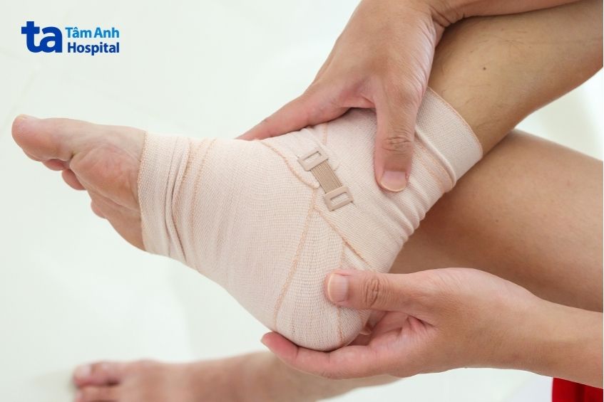 bong gân mắt cá chân cần được băng bó