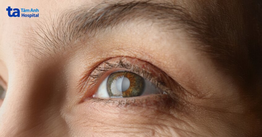 bức xạ làm ảnh hưởng mắt