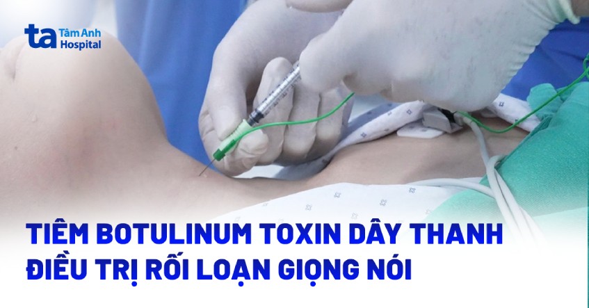 Tiêm botulinum toxin dây thanh điều trị rối loạn giọng nói