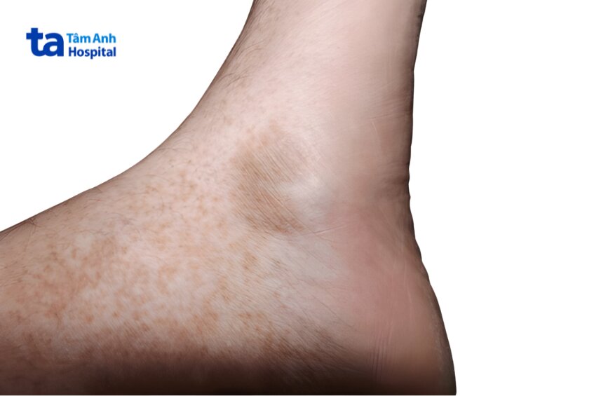 các thể bệnh xuất huyết sắc tố da thường gặp