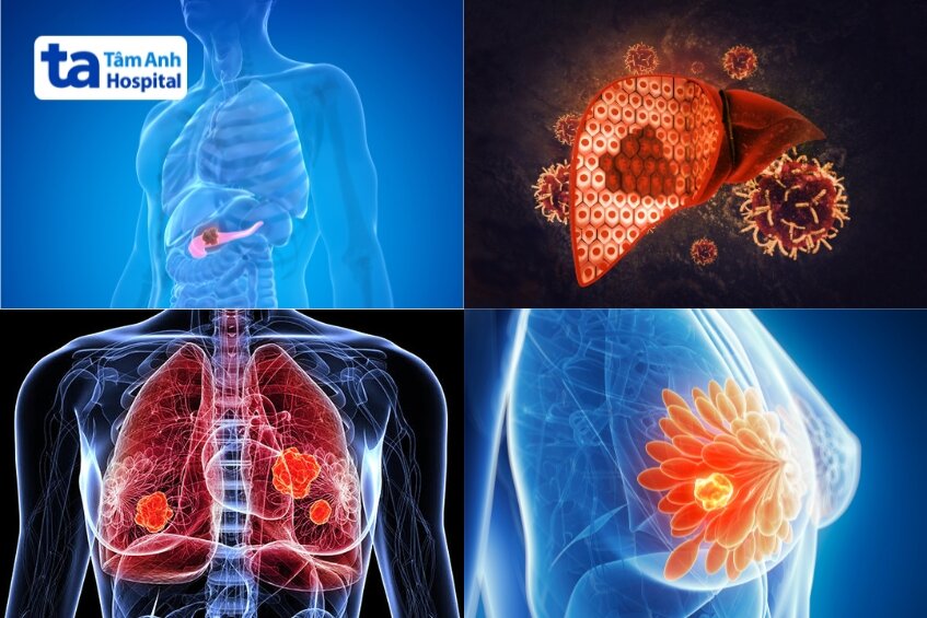 các trường hợp được chỉ định điều trị sgrt