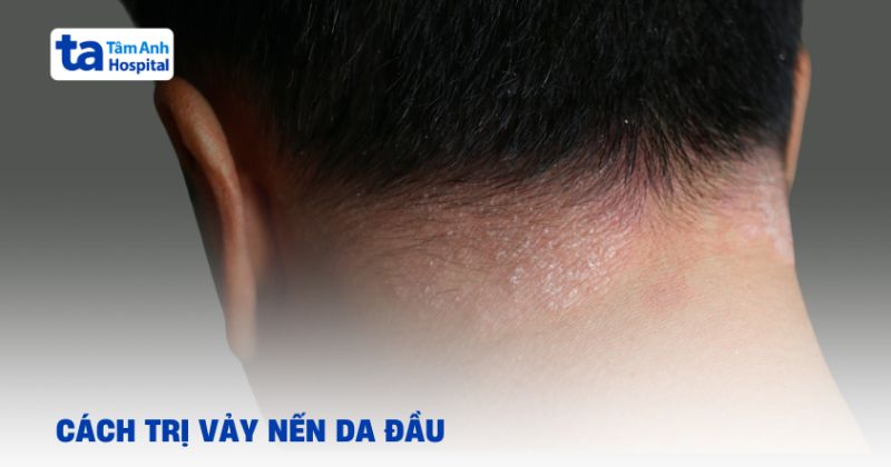 Cách trị vảy nến da đầu tại nhà và những điều cần lưu ý