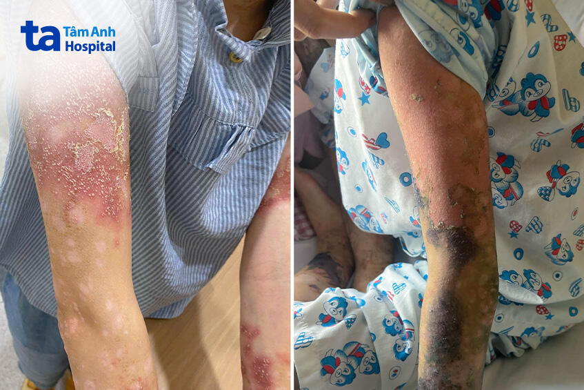 cánh tay nổi mụn mủ dày đặc
