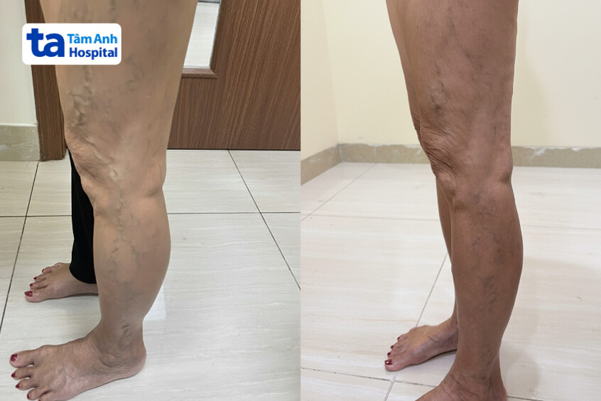 Chân bà Tư trước (ảnh trái) và sau (ảnh phải) điều trị suy giãn tĩnh mạch