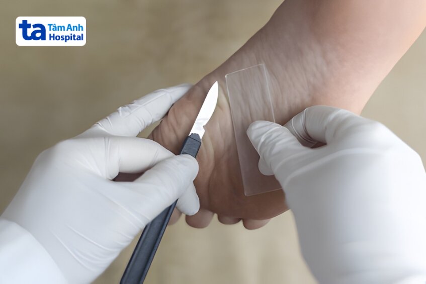 chẩn đoán da xuất huyết sắc tố