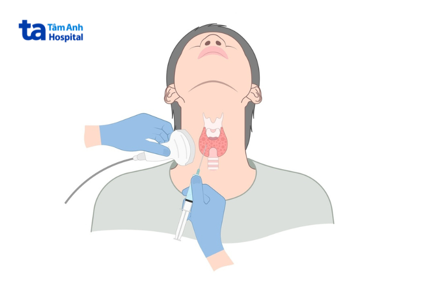 chỉ định fna được đưa ra dựa trên kích thước nhân giáp