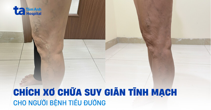 Chích xơ chữa suy giãn tĩnh mạch cho người bệnh tiểu đường