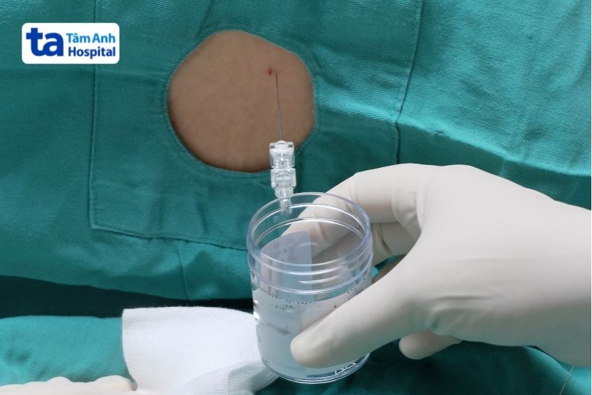 chọc dò tủy sống lấy mẫu