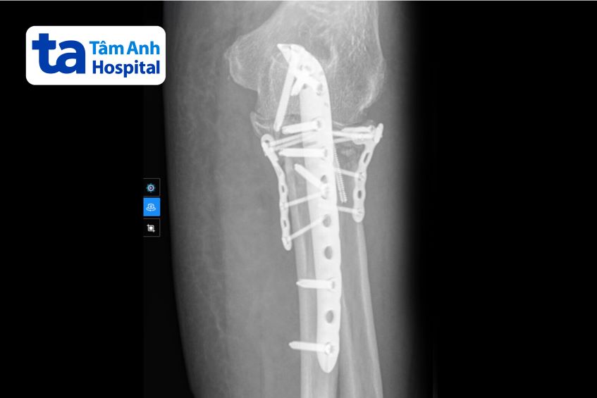 chụp x-quang tay phải