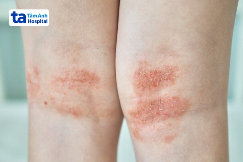 cơ chế hình thành tổn thương