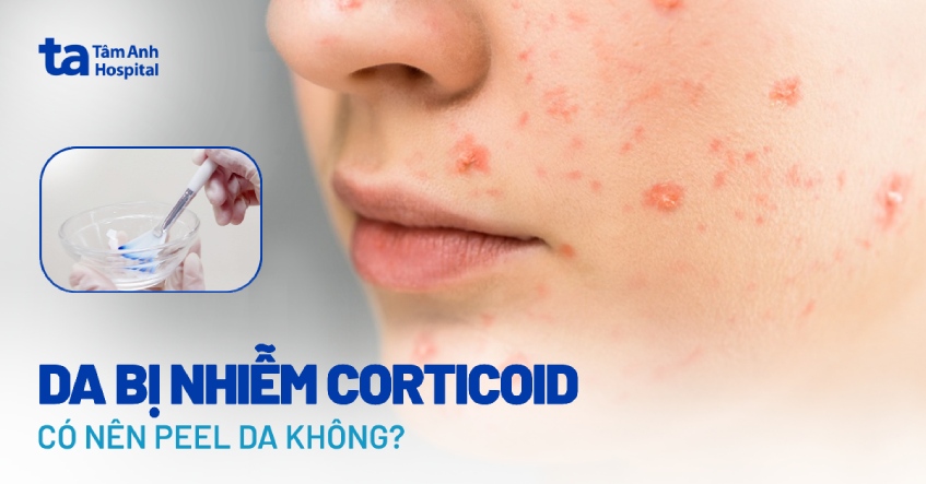 Da bị nhiễm corticoid có nên peel da không?