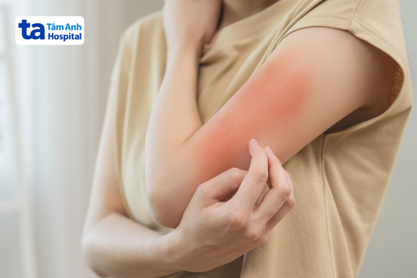 Vùng da tay bị đỏ kích ứng có thể do thiếu độ ẩm hoặc phản ứng với sản phẩm chăm sóc da
