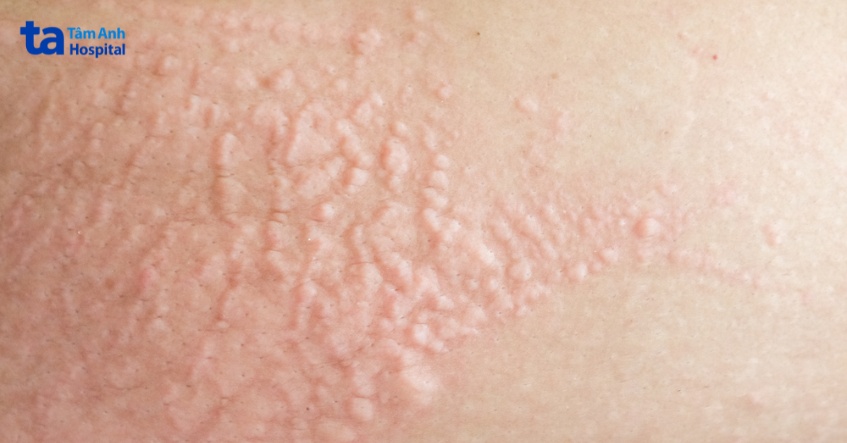 dấu hiệu mẹ bầu bị nổi mề đay