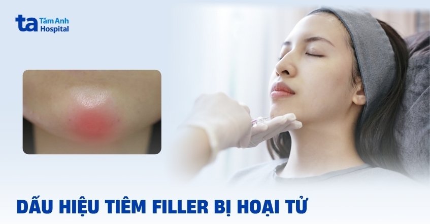 Dấu hiệu tiêm filler bị hoại tử da và cách xử lý kịp thời