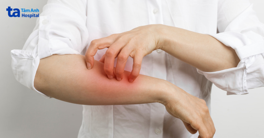 Người phụ nữ gãi vùng da tay bị dị ứng, có dấu hiệu mẩn đỏ