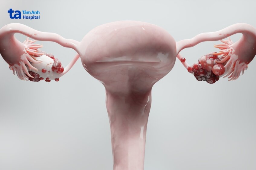 điều trị buồng trứng ưu tiên phẫu thuật hoặc hóa trị