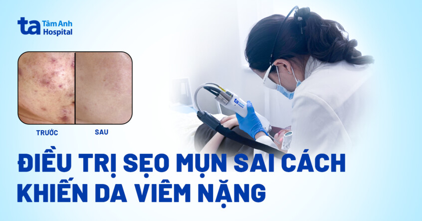 Điều trị sẹo mụn sai cách khiến da viêm nặng