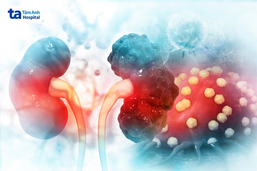 điều trị thận bằng phương pháp xạ trị