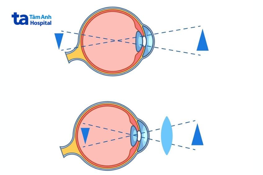 Mắt viễn thị điều chỉnh bằng kính