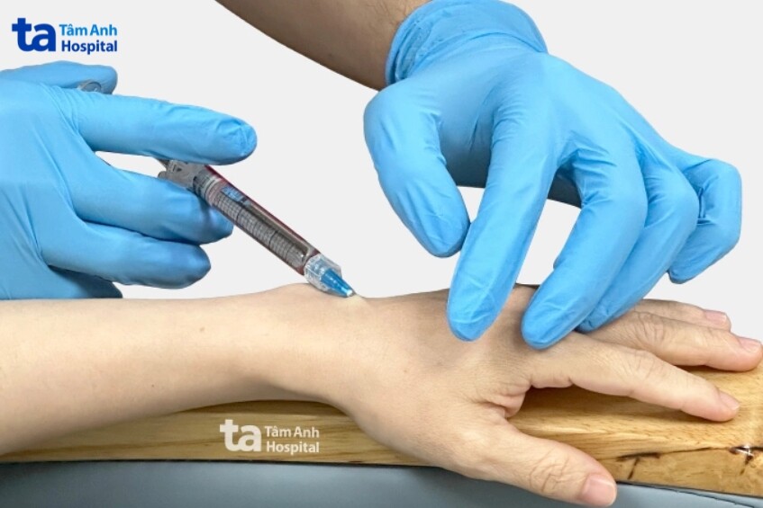 filler cần được tiêm đúng kỹ thuật